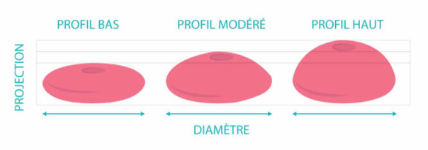 Projection et profil de la prothèse mammaire