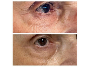 radiofrequence avant après