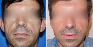 otoplastie avant / après