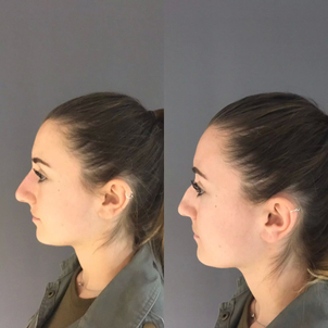 avant / après rhinoplastie
