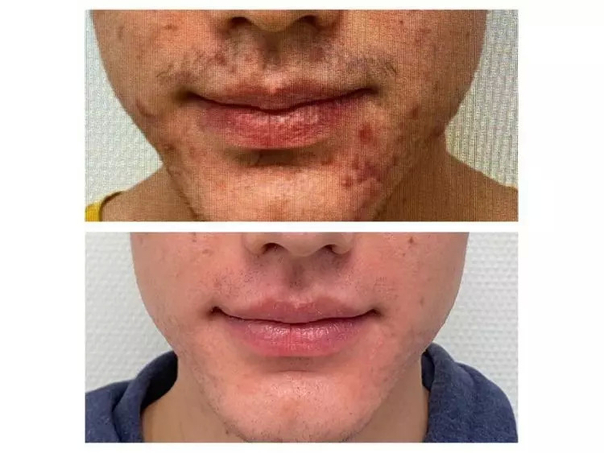 avant / après traitement anti acné