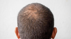 Calvitie à l'arrière du crâne