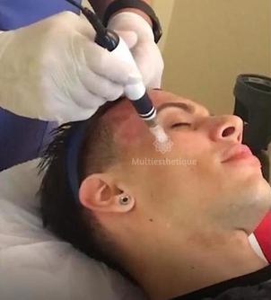 Qu'est-ce que la microdermabrasion