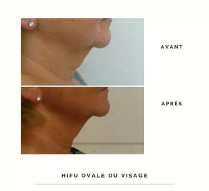 Avant / après HIFU