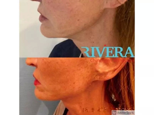 avant / après lifting