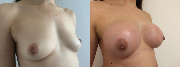avant / après lipofilling mammaire