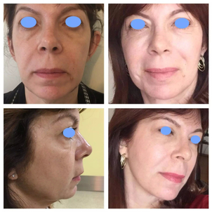 avant / après lifting