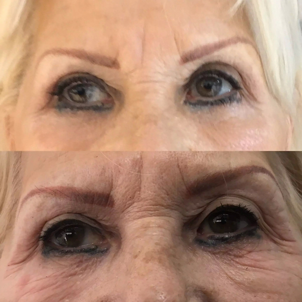 avant / après Botox