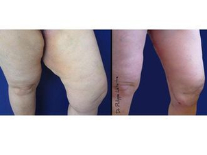 Dr Philippe Letertre - lifting des cuisses