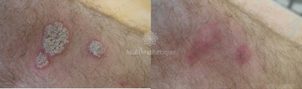 Psoriasis avant / après