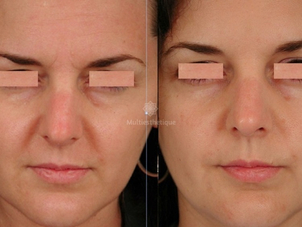 traitement anti rides avant après