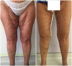 bodylift avant après