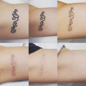 détatouage laser