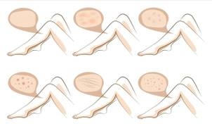 traitement anti-cellulite