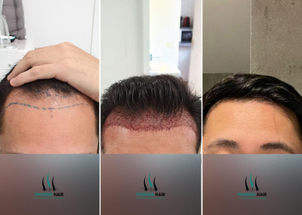 greffe de cheveux avant / après