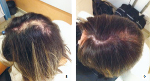 dermopigmentation avant apres