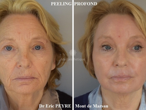 peeling avant / après