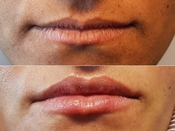 Avant / après augmentation des lèvres