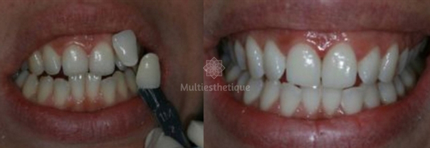 Blanchiment des dents avant / après