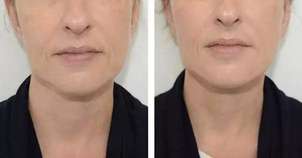 avant / après chirurgie maxillo-faciale