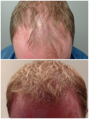 calvitie avant / après