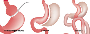 différentes techniques de réduction de l’estomac