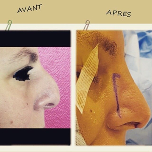 avant / après rhinoplastie