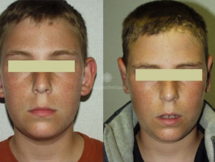 otoplastie avant / après