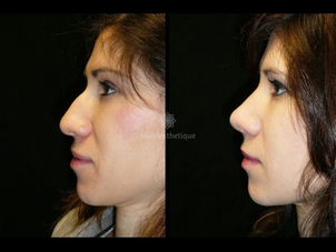 avant / après rhinoplastie