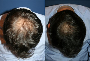 Traitement capillaire