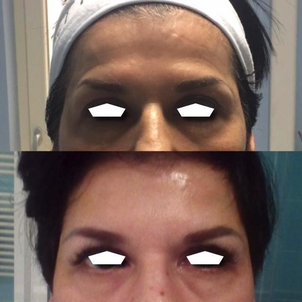 traitement anti rides avant après