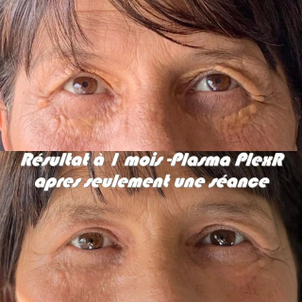 traitements xanthélasma