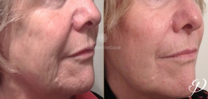 fils tenseurs avant / après