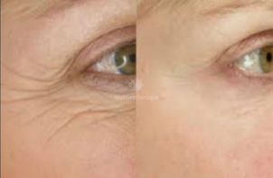 traitement anti rides avant après