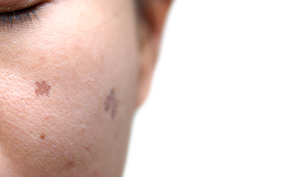 laser dermatologique