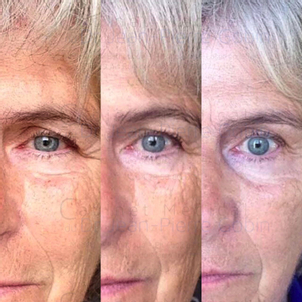 traitement anti rides avant après