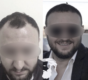 calvitie avant / après