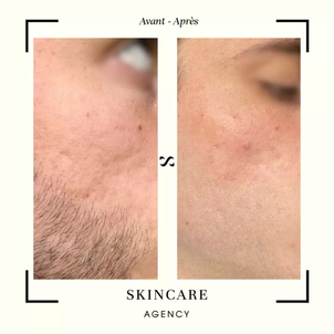 microneedling médical