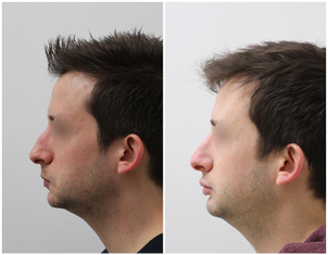 avant / après rhinoplastie