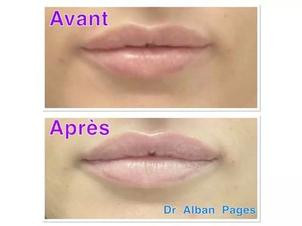 avant / après lifting de la lèvre supérieure