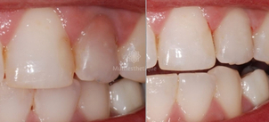 Blanchiment des dents avant / après