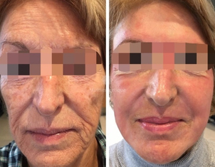 peeling avant / après