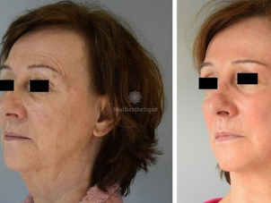 peeling avant / après