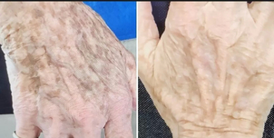 Avant / Après traitement