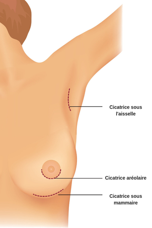 Cicatrices d'une augmentation mammaire