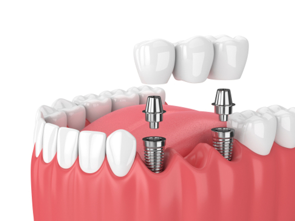 implants dentaire bridge