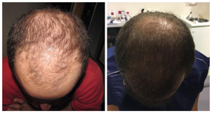 calvitie avant / après