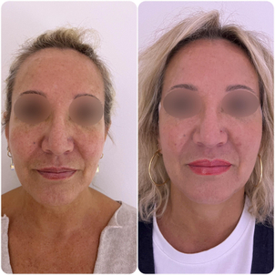 fils tenseurs avant / après