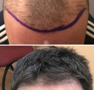 greffe de cheveux avant / après