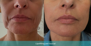 avant / après lipofilling peri buccal